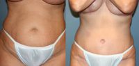 Laser Liposuction and Tummy Tuck