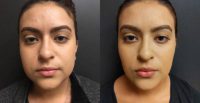24 year old woman treated with Buccal Fat Removal and Liposuction of the Neckline  (Submental Area)