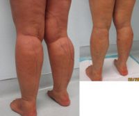 Liposculpture of Cankles