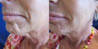45-54 year old woman treated with Juvederm in her marionette lines and lips