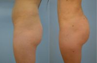 24 year old woman treated with Brazilian Butt Lift