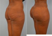 35 year old woman treated with Brazilian Butt Lift