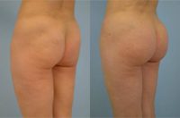 43 year old woman treated with Brazilian Butt Lift
