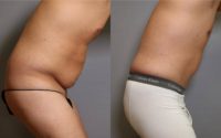 35-44 year old man treated with Tummy Tuck