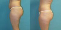 18-24 year old woman treated with Liposuction