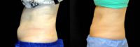 53 Year Old Female treated with Coolsculpting