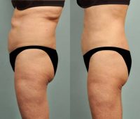 60 yr old female Smartlipo Laser Liposuction - Abdomen, hips, flanks, pubis 2 mo post op
