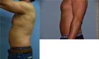 45-54 year old man treated with Liposuction