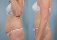 45-54 year old woman treated with Tummy Tuck by Dr. Alain Polynice