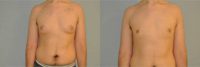 25 yo man treated with scarless breast reduction using only liposuction (No periareolar scar)