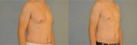 45 year old man treated with Male Breast Reduction