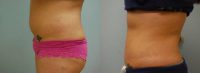 25-34 year old woman treated with Liposuction