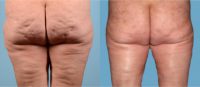 55-64 year old woman treated with Cellulite Treatment
