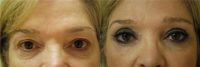 62 year old woman treated with Eyelid Surgery