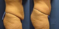 25-34 year old woman treated with Mini Tummy Tuck