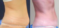 45-54 year old woman treated with Tumescent Liposuction