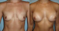 25-34 year old woman treated with Breast Augmentation