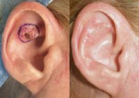 45-54 year old woman treated with Ear Surgery