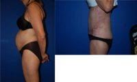 55-64 year old woman treated with Tummy Tuck