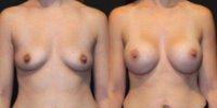 28 y/o, 5'6", 150 lbs, 505 cc saline breast implants