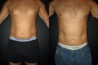 38 year old man treated with Liposuction