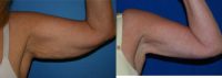 55-64 year old woman treated with Arm Lift