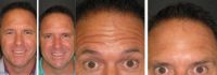 "Brotox"/Botox Before & After Overall Result