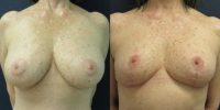 55-64 year old man treated with Breast Reduction