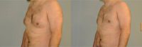 34 year old man treated with liposuction of gynecomastia (no gland excision)