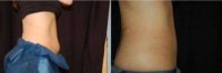 CoolSculpting Before and After Pictures