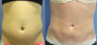 Female Liposuction, Upper abs, Lower abs & Waist