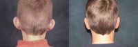 17 or under year old man treated with Ear Surgery
