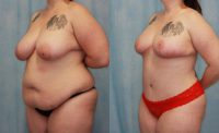 35 year old woman treated with Mommy Makeover