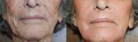 65-74 year old woman treated with Laser Resurfacing with J-Plasma