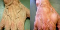 65-74 year old woman treated with Radiesse