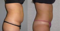 25-34 year old woman treated with Smart Lipo
