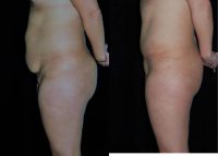 25-34 year old woman treated with Drainless Ipanema Tummy Tuck