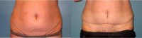 Dr. Gregory Baum, MD, Syracuse Plastic Surgeon - 52 Year Old Woman Treated With Tummy Tuck