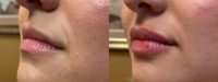 25-34 year old woman treated with Lip Filler