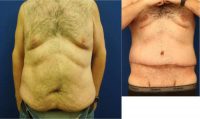 25-34 year old man treated with Tummy Tuck