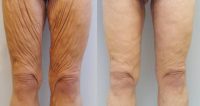 55-64 year old woman treated with Thigh Lift