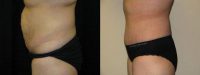 Dr. James Knoetgen, III, MD, Fresno Plastic Surgeon - 43 Year Old Female With A Tummy Tuck