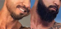 40 year old man treated with Beard Transplant