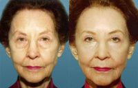 Skin Resurfacing - Before & After