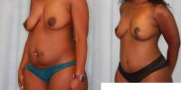 25-34 year old woman treated with Mommy Makeover