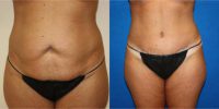 35-44 year old woman treated with Liposuction