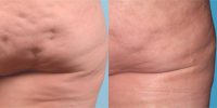 55-64 year old woman treated with Cellulite Treatment