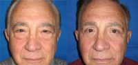 77 year old man treated with upper and lower eyelid surgery