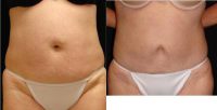 Dr. Michael J. Denk, MD, Virginia Beach Plastic Surgeon - 48 Year Old Woman Treated With Tummy Tuck Before