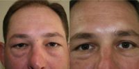 35-44 year old man treated with Eyelid Surgery